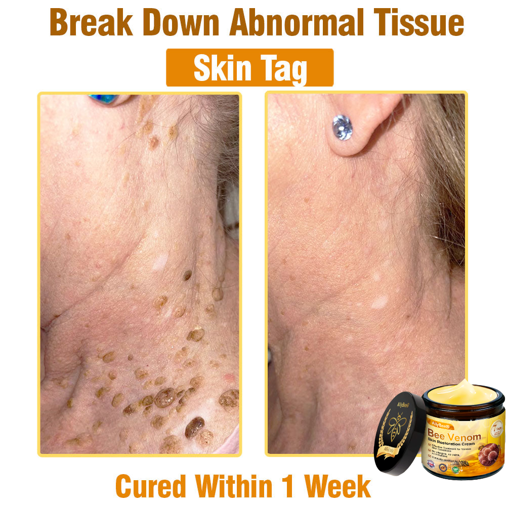 🇬🇧 St John's Institute of Dermatology Official: AllyBee® Skin Treatment Cream Anti-aging, Hydrating, Skin Repair, Even Tone, Acne and Dark Spot Treatment, Wart and Mole Removal, Psoriasis Relief