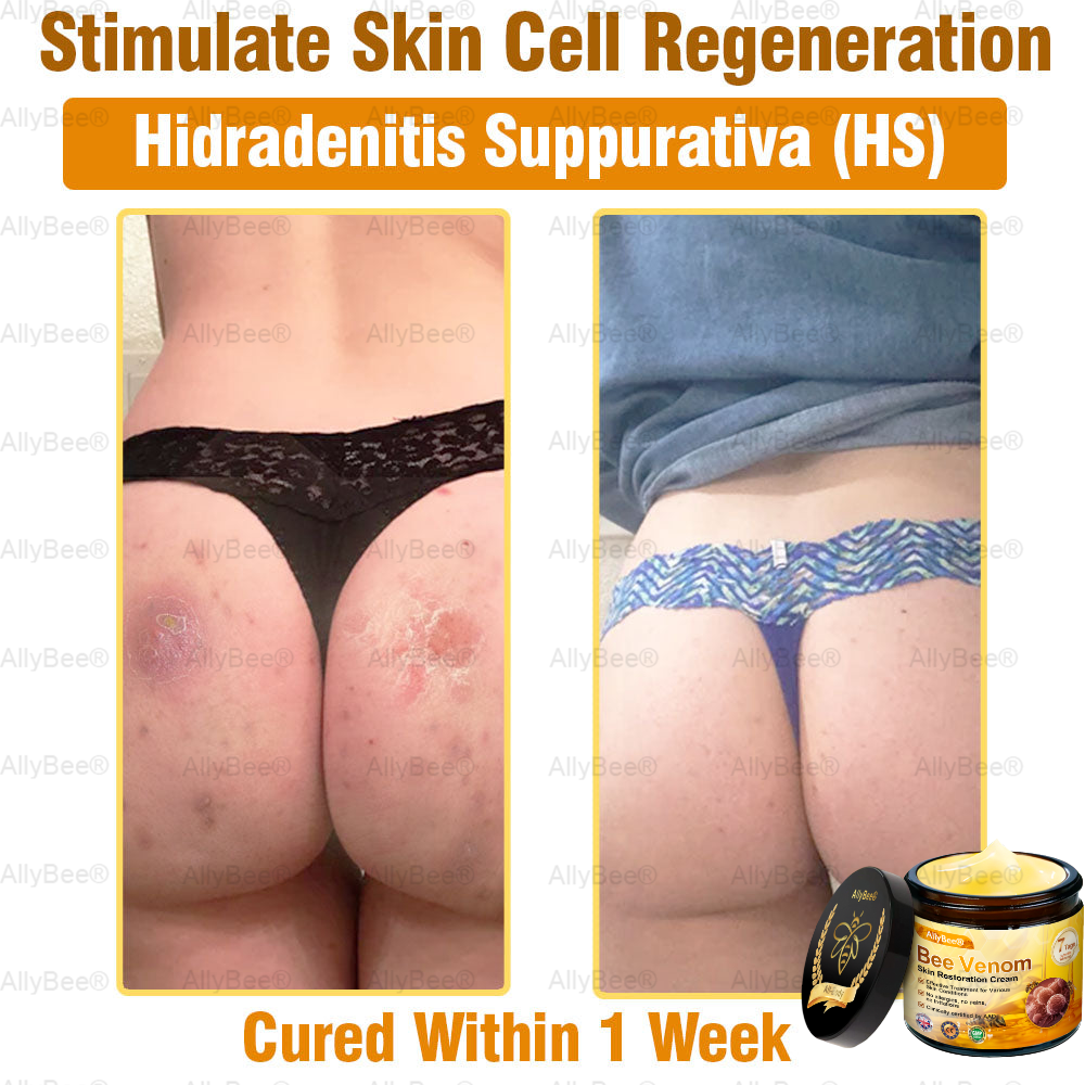 🇬🇧 St John's Institute of Dermatology Official: AllyBee® Skin Treatment Cream Anti-aging, Hydrating, Skin Repair, Even Tone, Acne and Dark Spot Treatment, Wart and Mole Removal, Psoriasis Relief