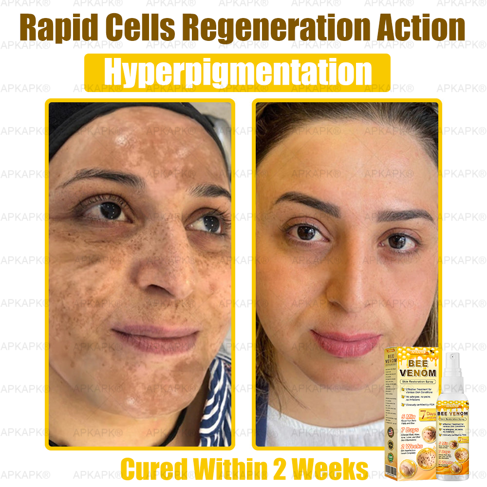 š APKAPKĀ® has a surprise upgrade just for you! Youāve already received an amazing offer ā but now youāve unlocked an even better one: š„ Get a massive 50% OFF your next purchase of APKAPKĀ® Bee Venom Skin Restoration Spray ā for the next two minutes only!