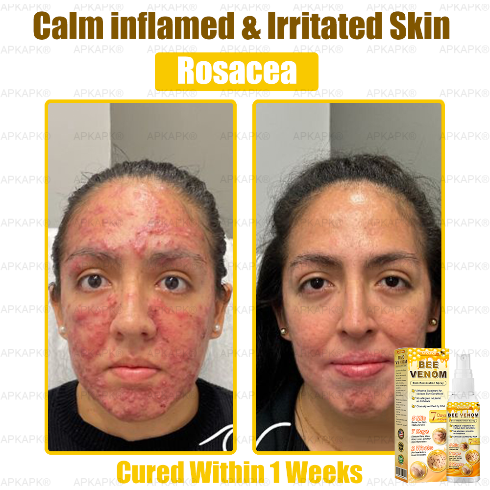 š APKAPKĀ® has a surprise upgrade just for you! Youāve already received an amazing offer ā but now youāve unlocked an even better one: š„ Get a massive 50% OFF your next purchase of APKAPKĀ® Bee Venom Skin Restoration Spray ā for the next two minutes only!