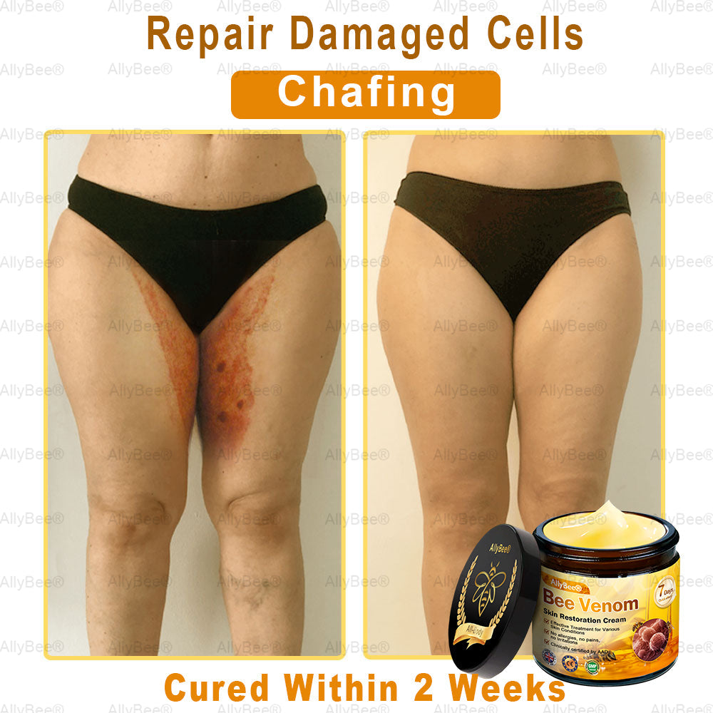 🇬🇧 St John's Institute of Dermatology Official: AllyBee® Skin Treatment Cream Anti-aging, Hydrating, Skin Repair, Even Tone, Acne and Dark Spot Treatment, Wart and Mole Removal, Psoriasis Relief