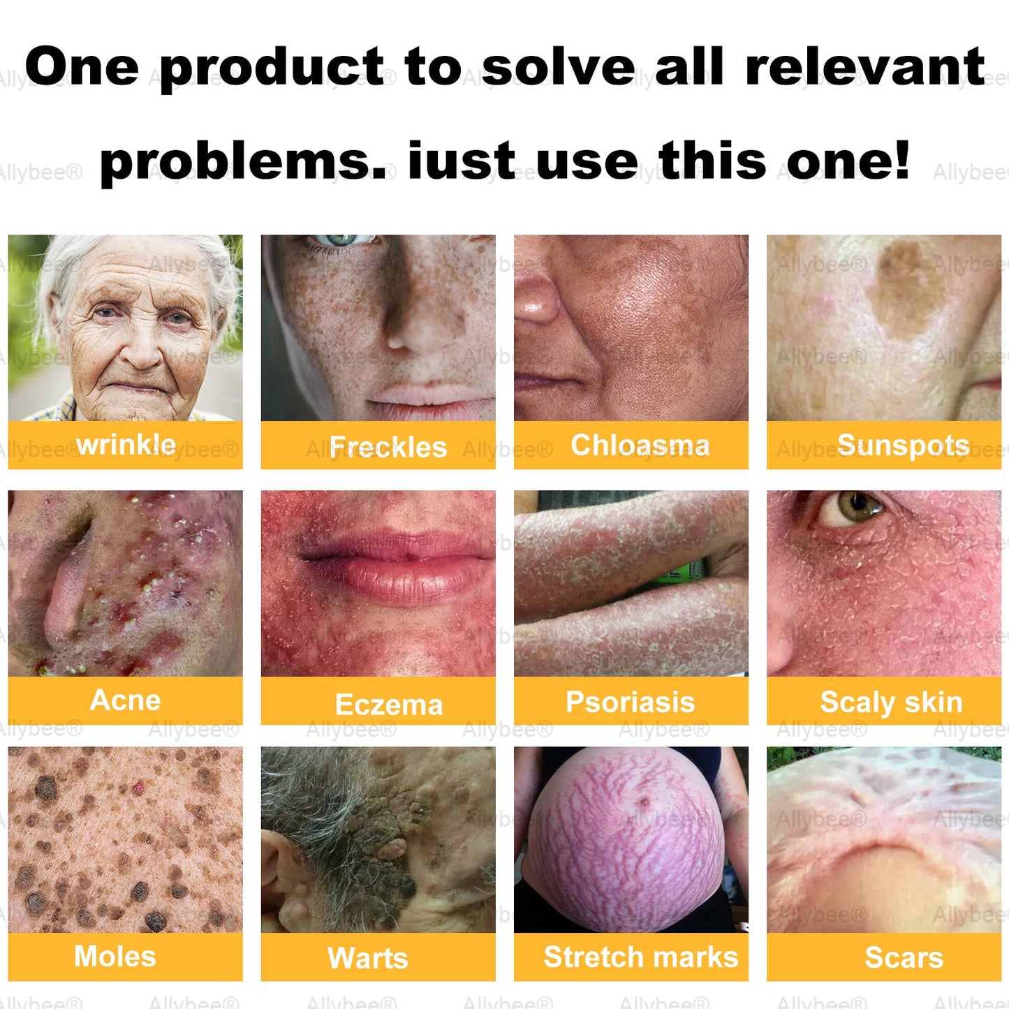 🇬🇧 St John's Institute of Dermatology Official: AllyBee® Skin Treatment Cream Anti-aging, Hydrating, Skin Repair, Even Tone, Acne and Dark Spot Treatment, Wart and Mole Removal, Psoriasis Relief