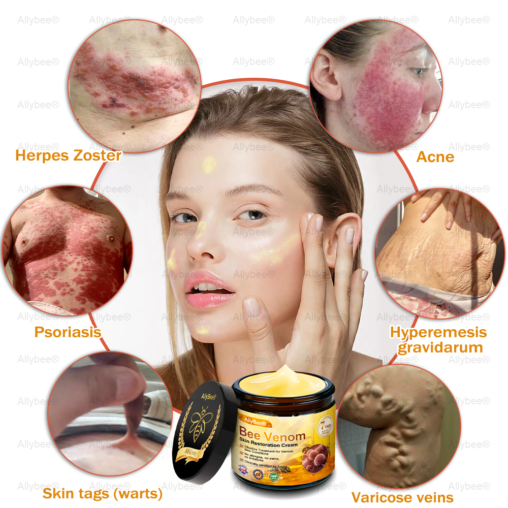 🇬🇧 St John's Institute of Dermatology Official: AllyBee® Skin Treatment Cream Anti-aging, Hydrating, Skin Repair, Even Tone, Acne and Dark Spot Treatment, Wart and Mole Removal, Psoriasis Relief