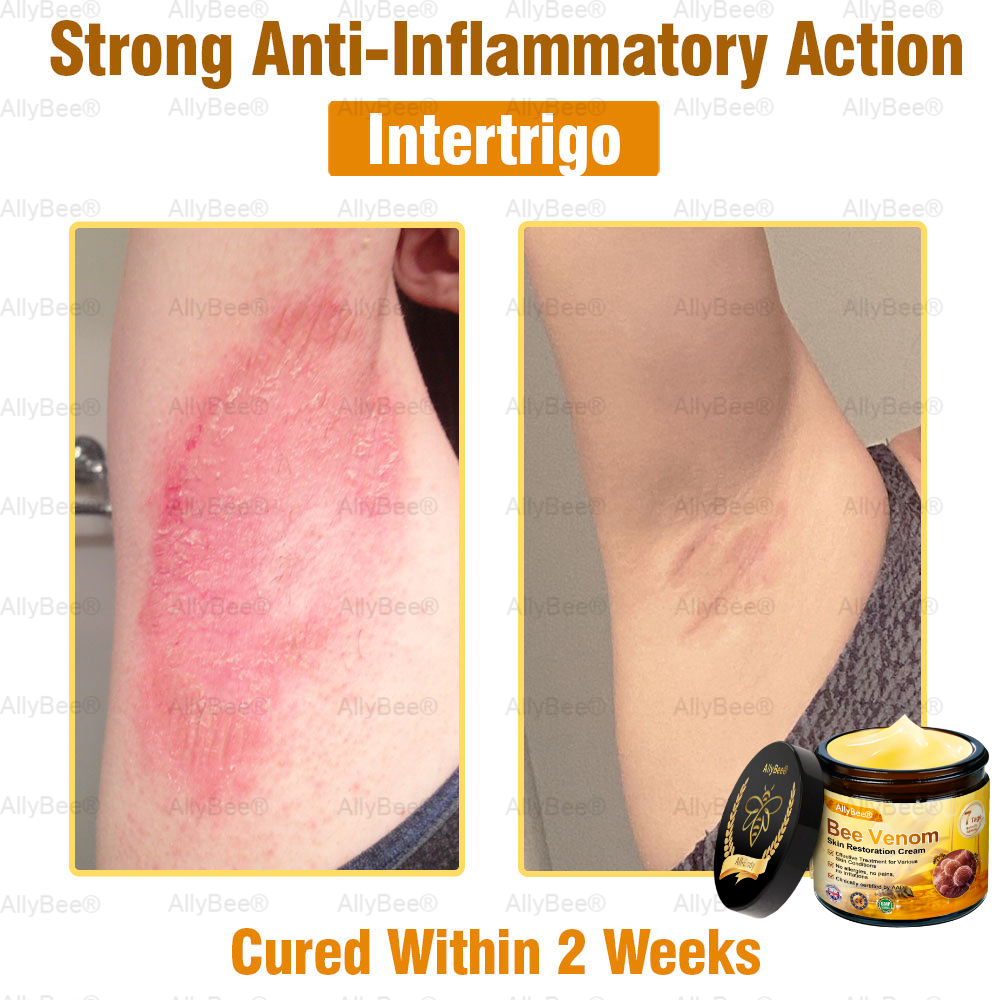 🇬🇧 St John's Institute of Dermatology Official: AllyBee® Skin Treatment Cream Anti-aging, Hydrating, Skin Repair, Even Tone, Acne and Dark Spot Treatment, Wart and Mole Removal, Psoriasis Relief