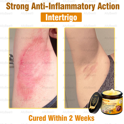 🇬🇧 St John's Institute of Dermatology Official: AllyBee® Skin Treatment Cream Anti-aging, Hydrating, Skin Repair, Even Tone, Acne and Dark Spot Treatment, Wart and Mole Removal, Psoriasis Relief