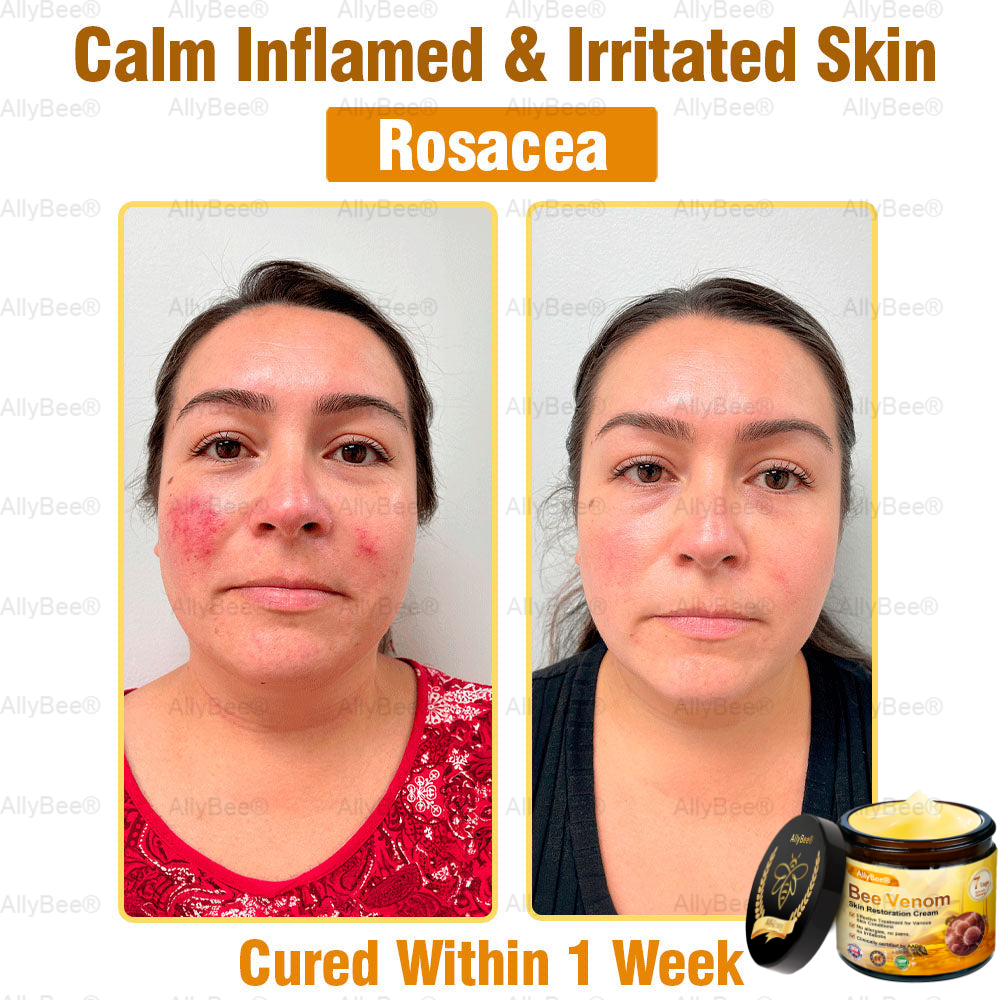 🇬🇧 St John's Institute of Dermatology Official: AllyBee® Skin Treatment Cream Anti-aging, Hydrating, Skin Repair, Even Tone, Acne and Dark Spot Treatment, Wart and Mole Removal, Psoriasis Relief