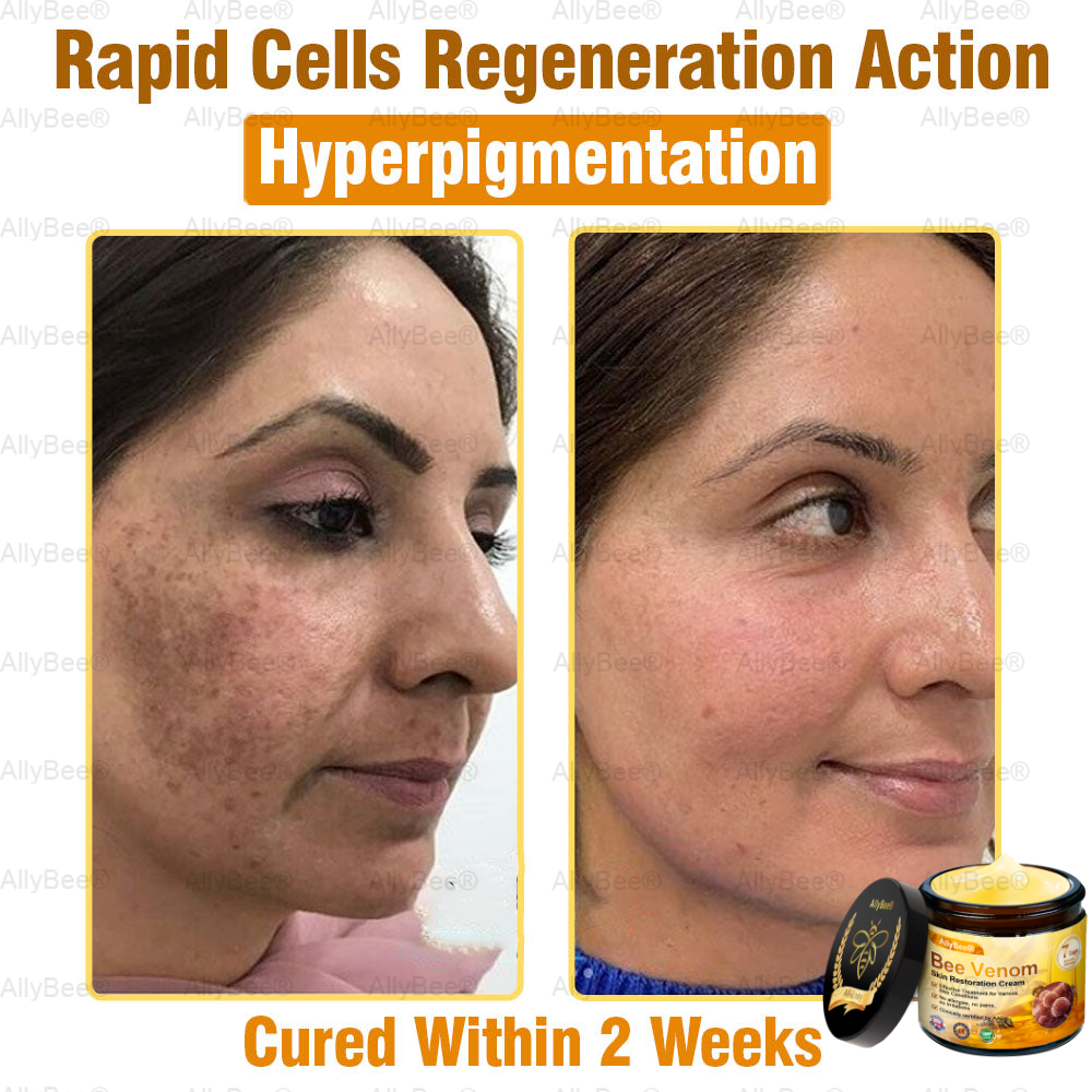 🇬🇧 St John's Institute of Dermatology Official: AllyBee® Skin Treatment Cream Anti-aging, Hydrating, Skin Repair, Even Tone, Acne and Dark Spot Treatment, Wart and Mole Removal, Psoriasis Relief