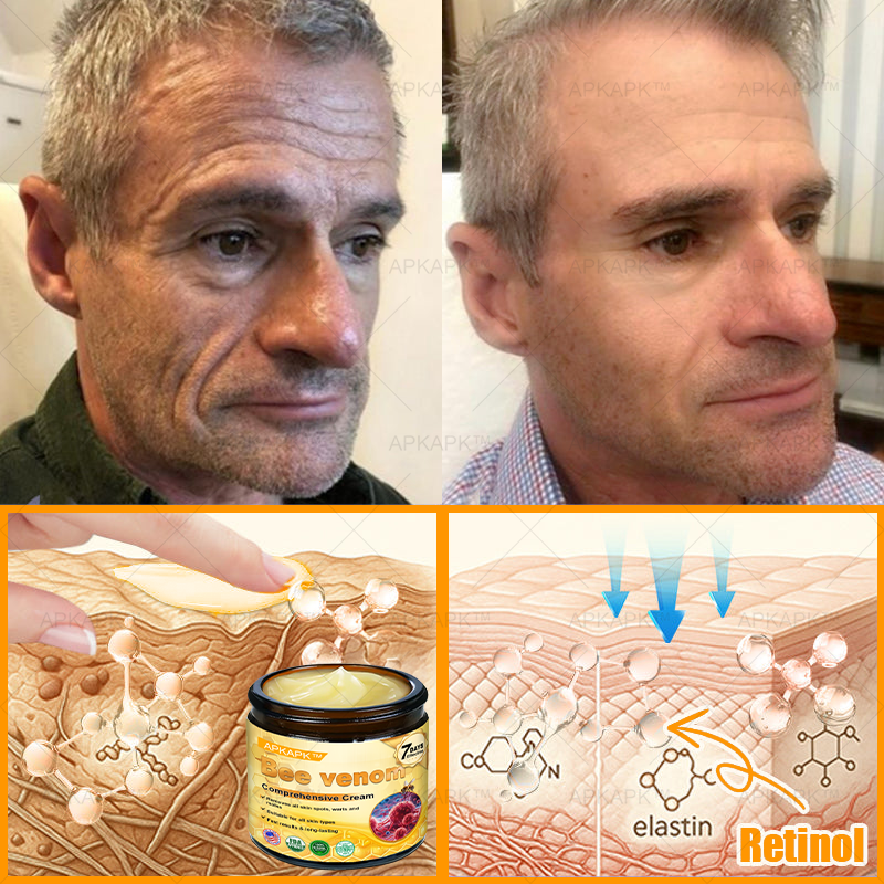 💥 For a limited time only: 50% off AРKAРК™ Bee Venom Comprehensive Cream – for the next 2 minutes! Don’t miss out – this exclusive upgrade is available for a short time only! 💥